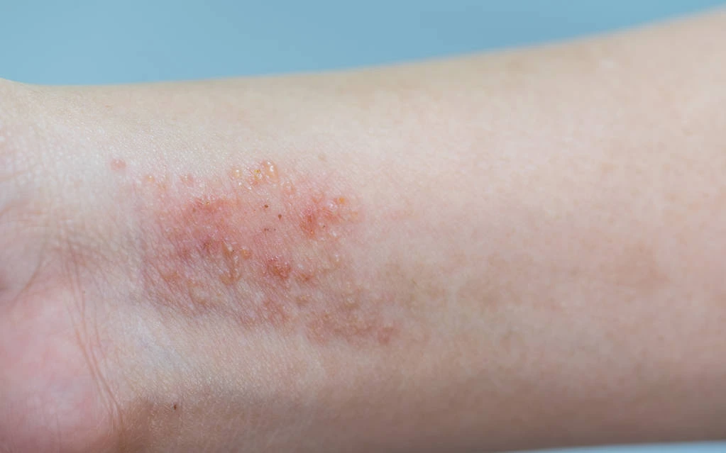 Stock Photo Atopic Dermatitis Symptom Skin (1)